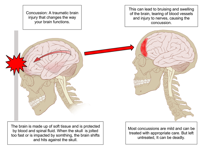 Traumatic Brain Injuries Pathways To Health